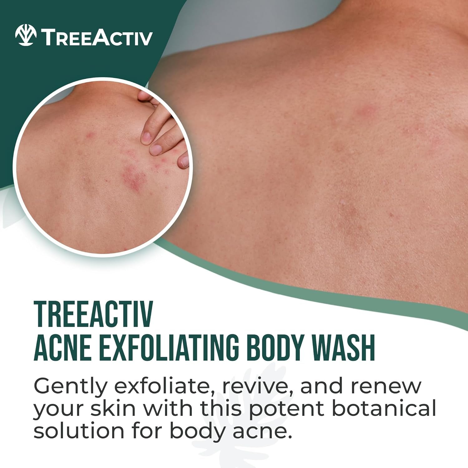 Exfoliating Acne Body Wash 8 Fl Oz Body Acne Wash for Back, Chest, Shoulder, Back Acne Treatment with Jojoba Beads, Back Acne Body Wash for Bacne, Soothing Body Acne Treatment for Men, Women